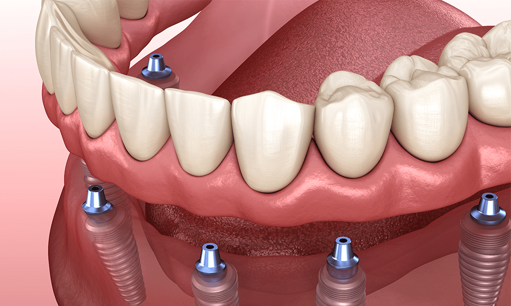 Implant Denture Voss Dental