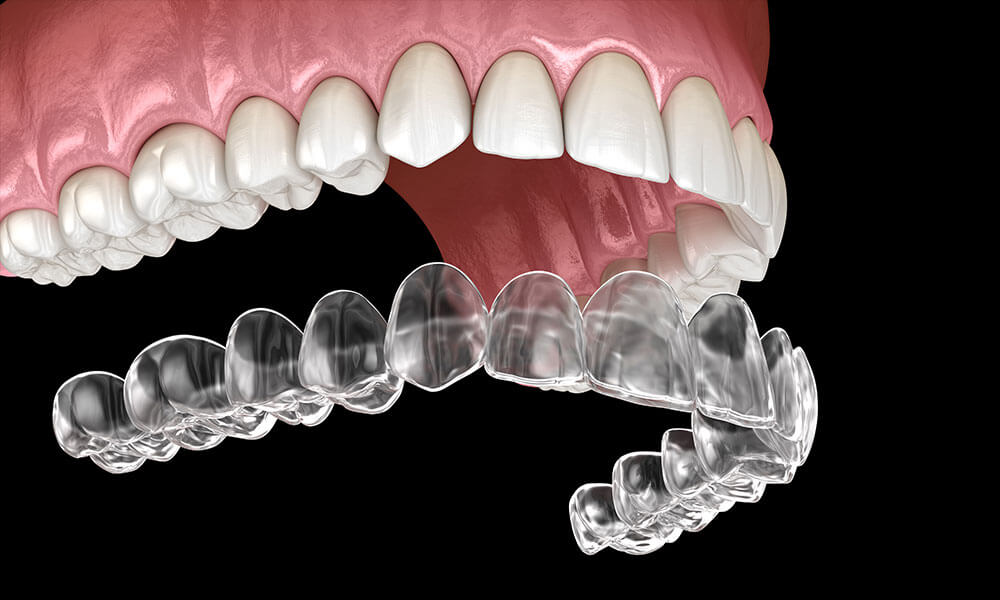 Invisalign-Houston