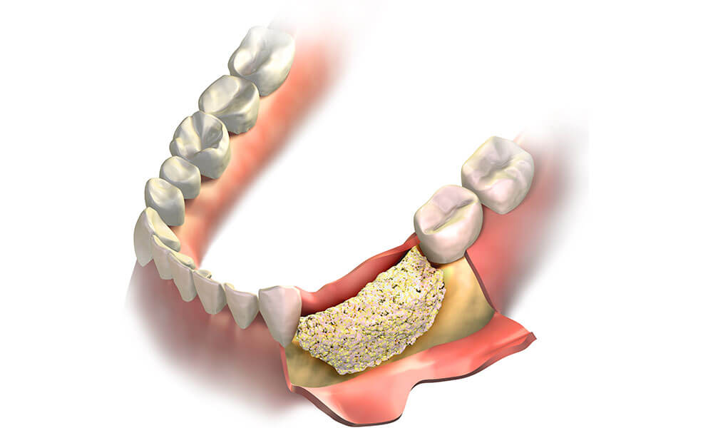 Is Dental Bone Grafting Expensive?