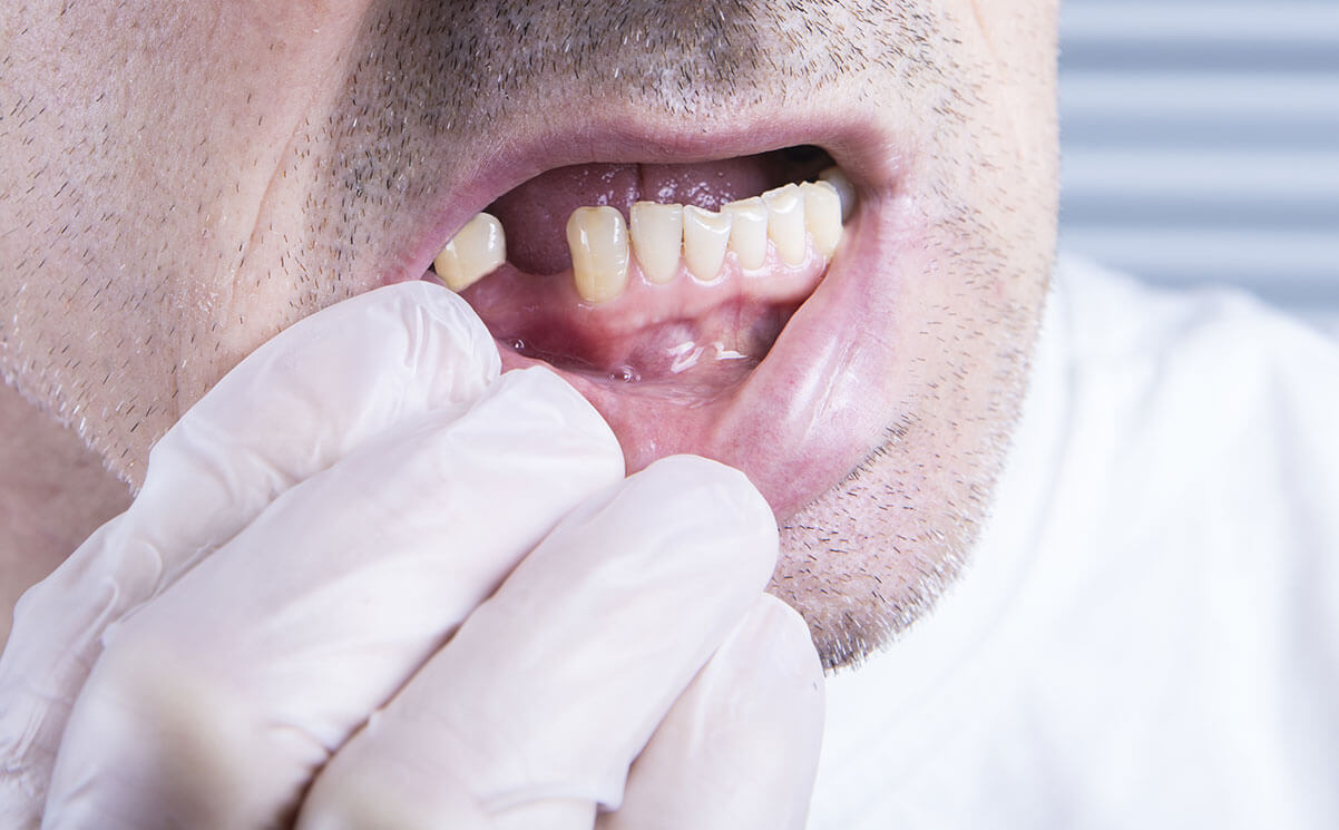 What To Do When Your Tooth Falls Out