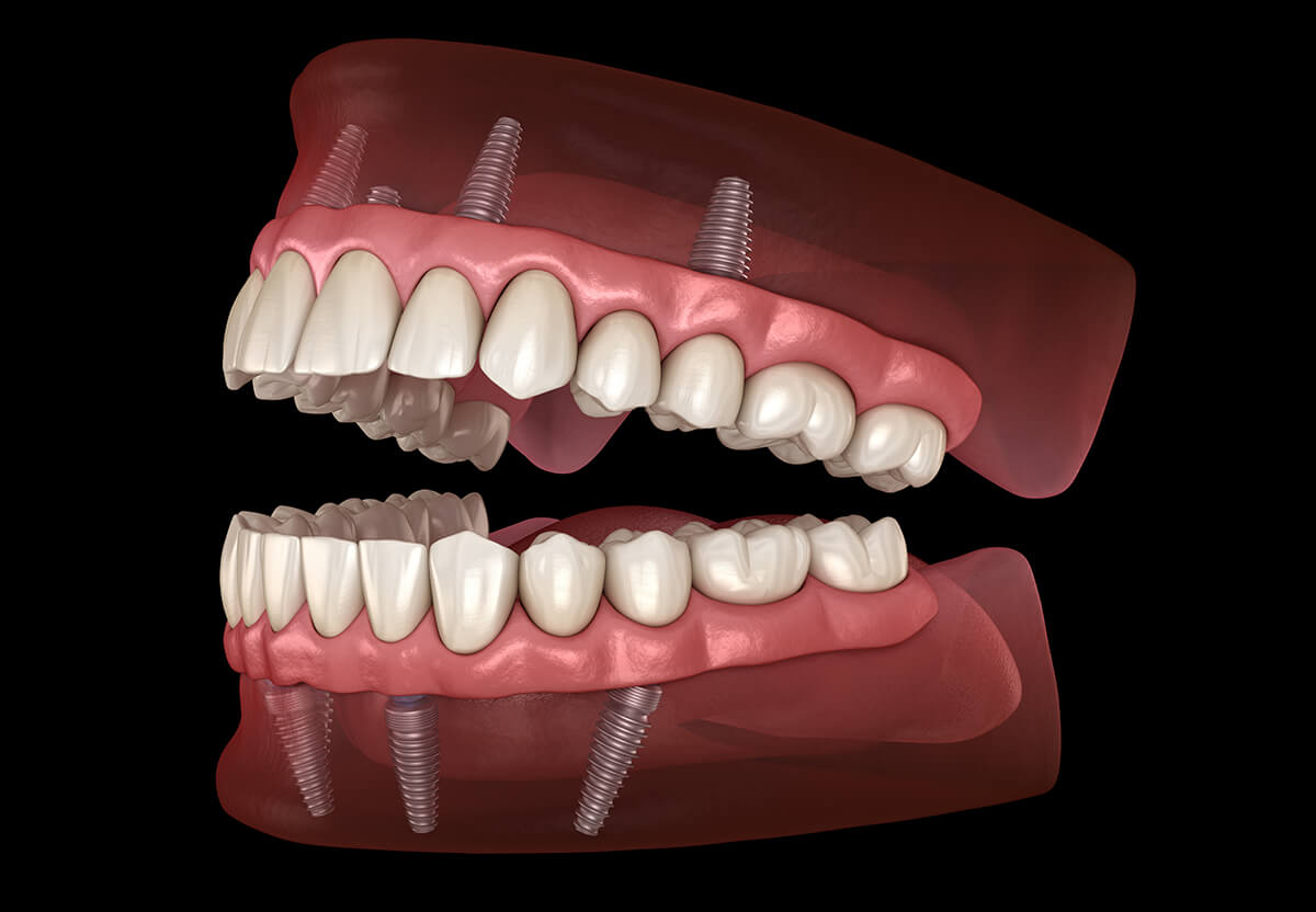 all on 4 dental implants Houston, Texas