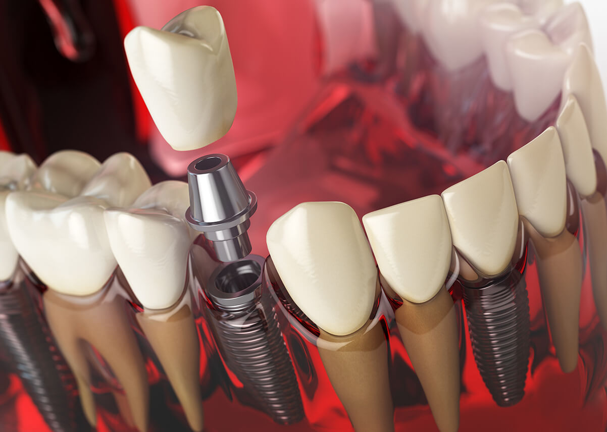 What you need to know about False Teeth in 2020 | Voss Dental - Oral Surgery | Implant