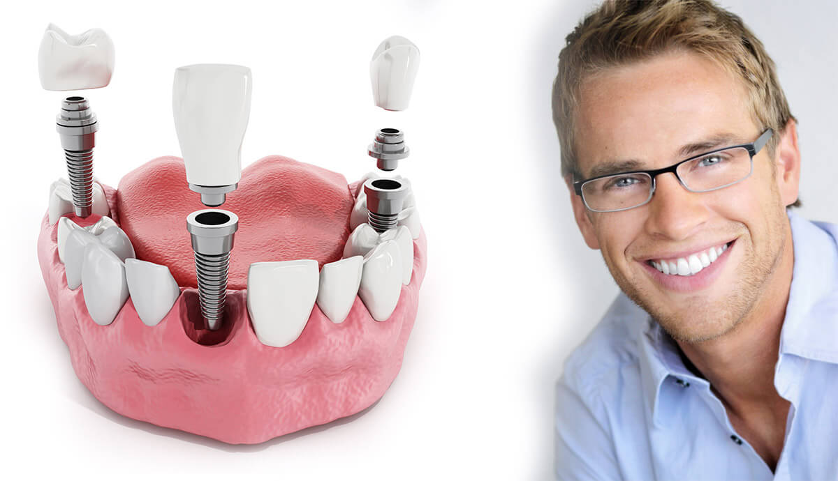 affordable dental implants in Houston, TX