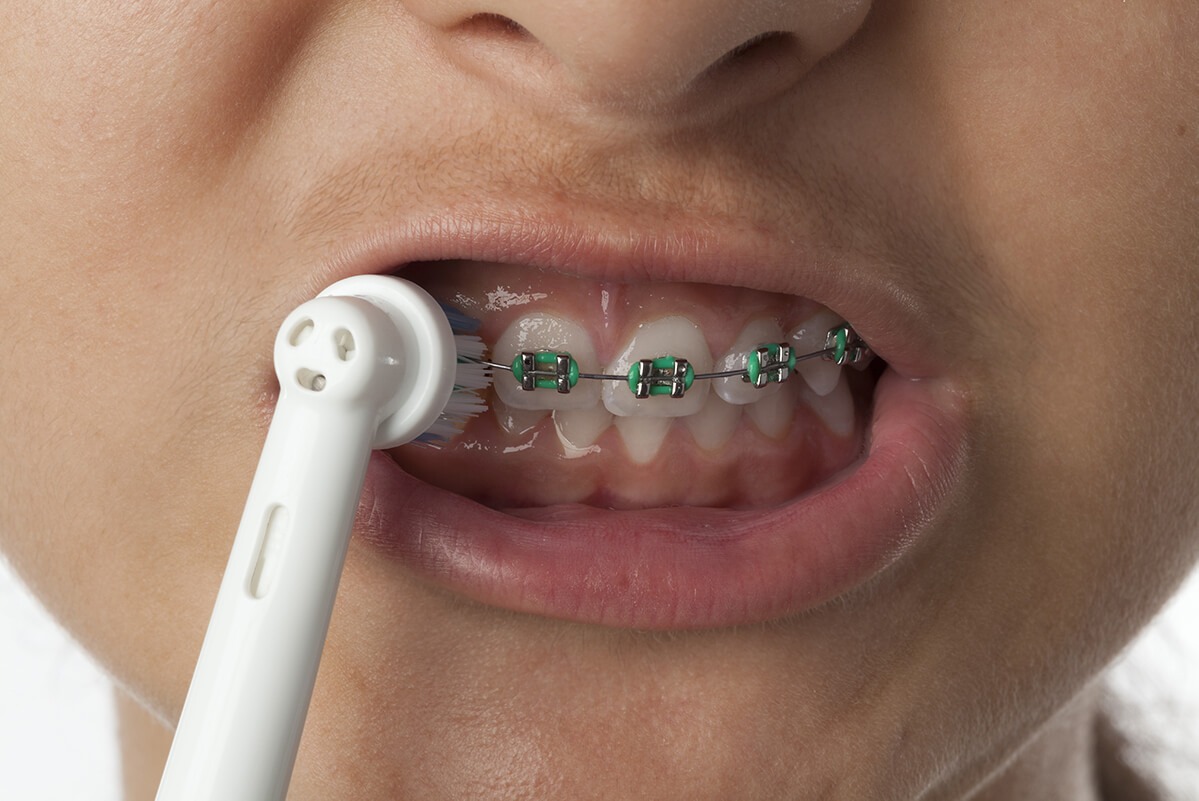 Electric Toothbrush and braces
