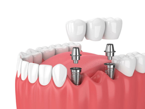 how-much-does-a-dental-bridge-cost-with-insurance-voss-dental-oral