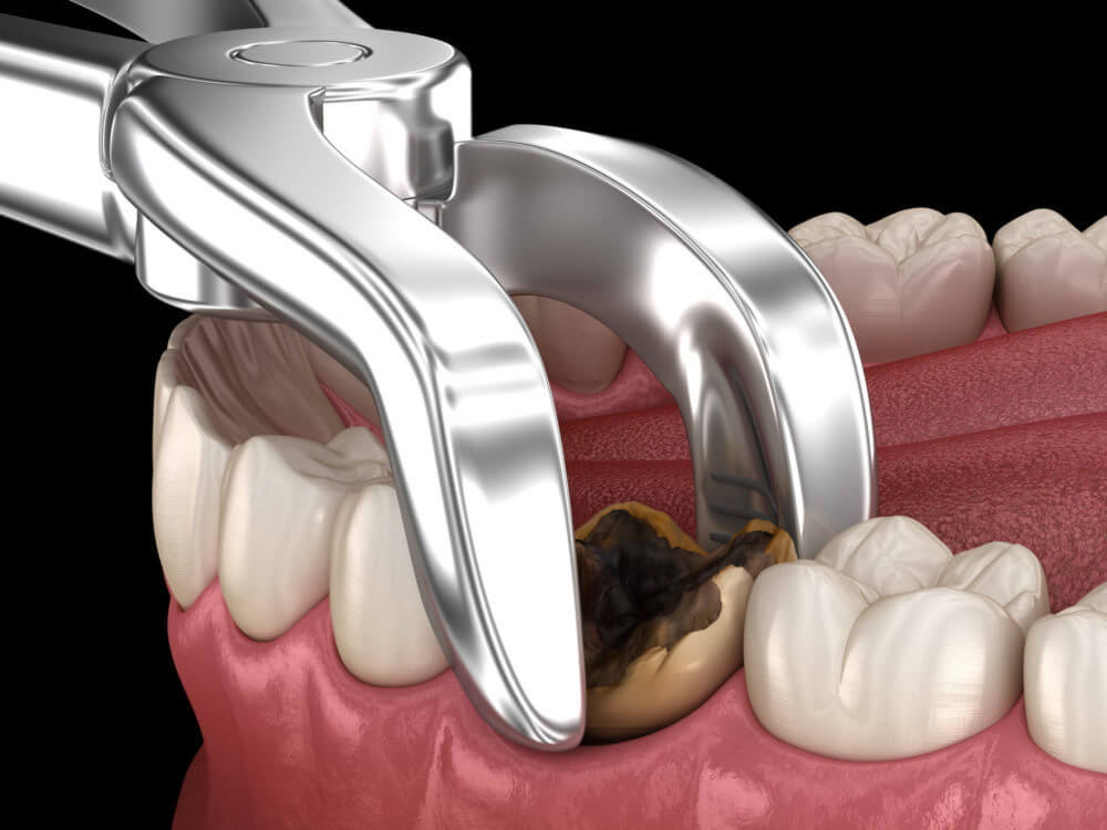 granulation tissue mouth