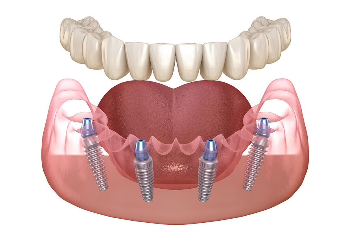 all on 4 dental implants problems