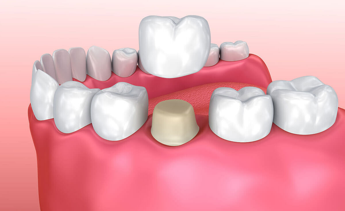 Dental Crown Fell Out, Causes and Treatment Options Voss Dental