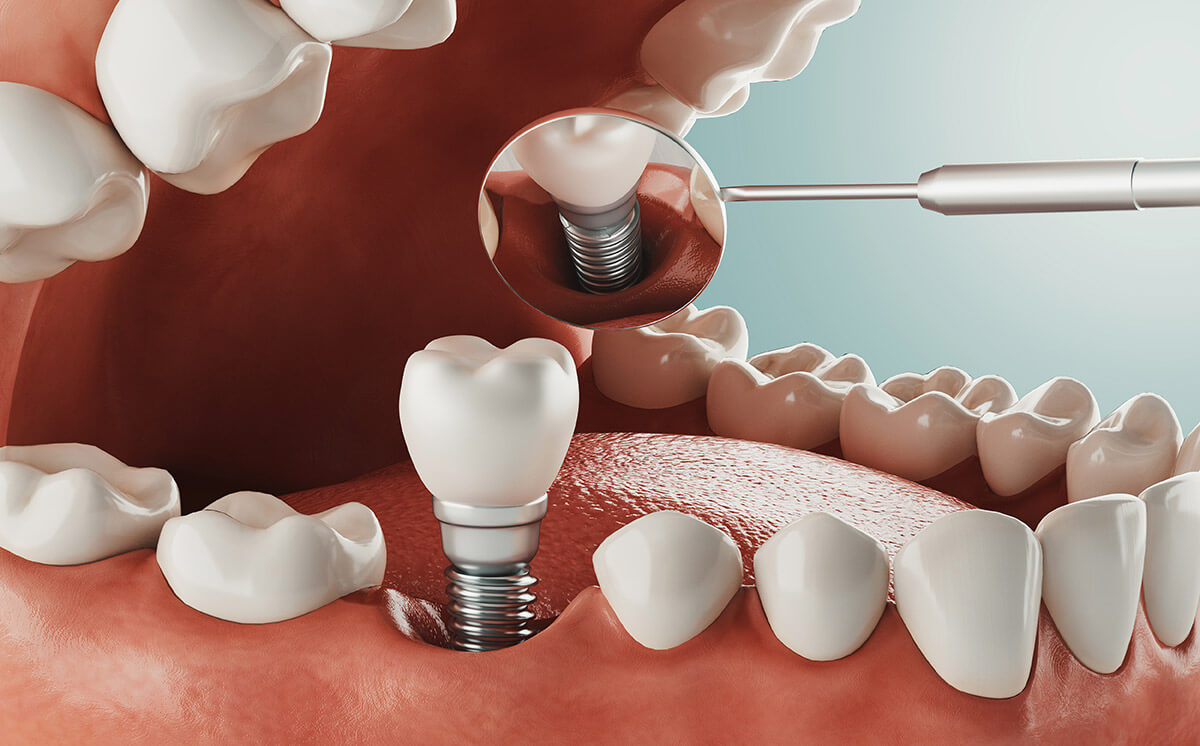 Does Blue Cross Cover Teeth Implants