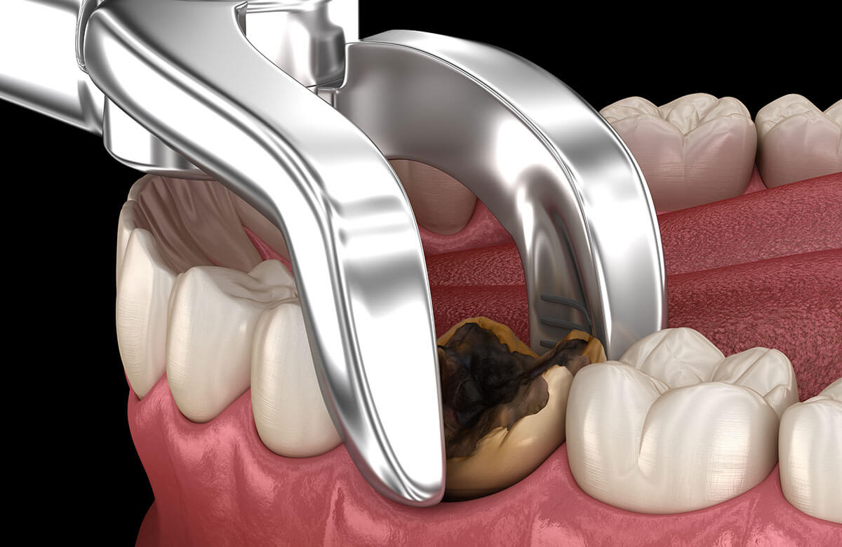 normal healing after tooth extraction