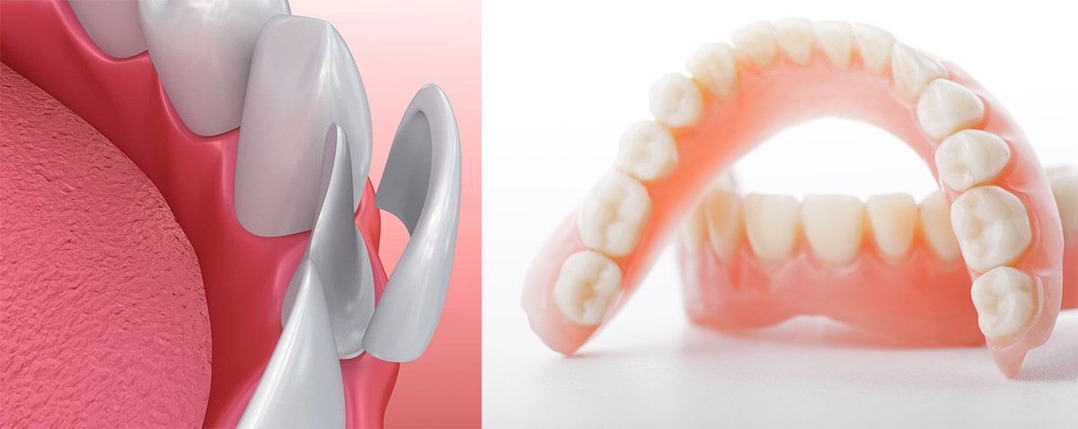 veneers vs. dentures