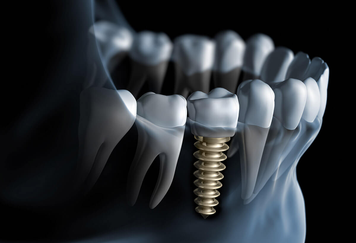 Dental Implants Safty